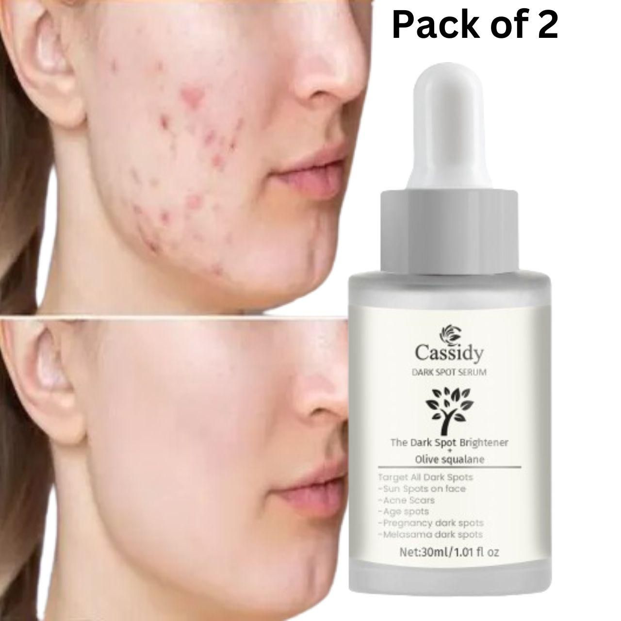 OS CASSIDY Dark Spot Serum Dark Spot Brightener and Olive Squalane Remove Acne Scars (Pack of 2) PRODUCT CODE (OS0001211)